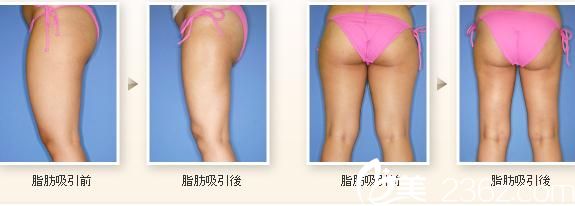 日本 TIARA 整形外科醫(yī)院  吸脂