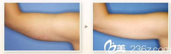 日本 TIARA 整形外科醫(yī)院 吸脂手術(shù)