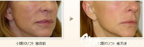 小臉3D提升術(shù)
