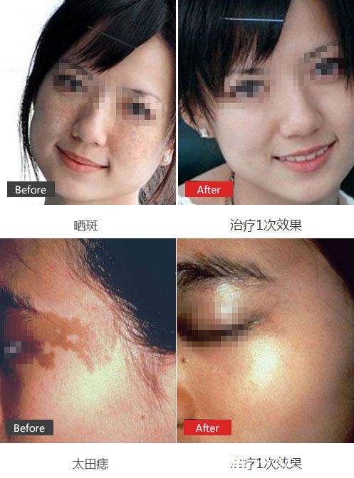 臺州維多利亞魏萍祛斑<span style=