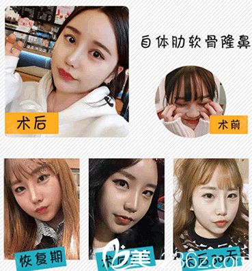 常州美貝爾隆鼻<span style=