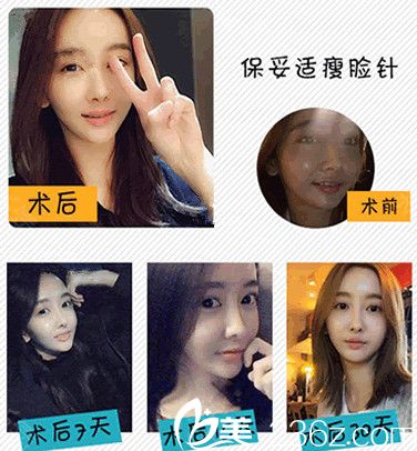 我在常州美貝爾打了瘦臉前后對比照