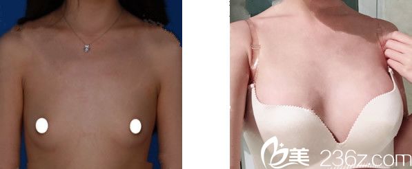 蘭州時(shí)光自體脂肪隆胸效果案例