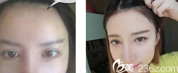 蘭州時(shí)光羅梅發(fā)際線種植一個(gè)月前后效果對(duì)比案例