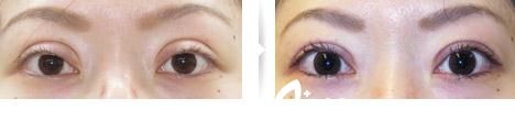 切開法雙眼皮修復(fù)