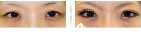 切開法雙眼皮修復(fù)1