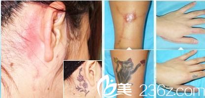 刺青傷疤去除