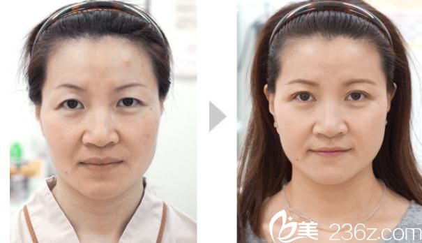 川崎整形醫(yī)院開眼角+雙眼皮手術(shù)1