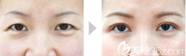 川崎整形醫(yī)院開眼角+雙眼皮手術(shù)2