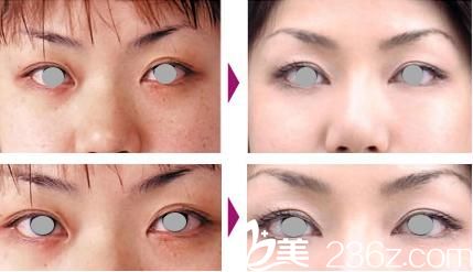  高牟禮雙眼皮修復(fù)