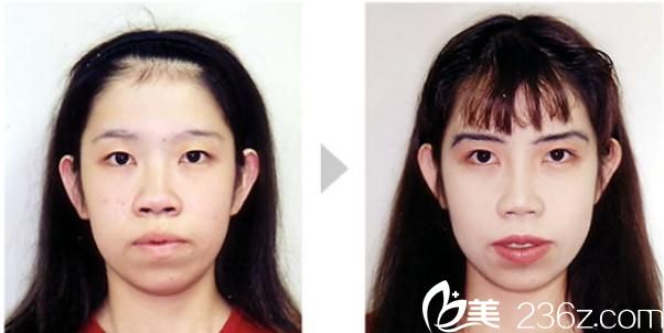  高牟禮隆鼻術(shù)