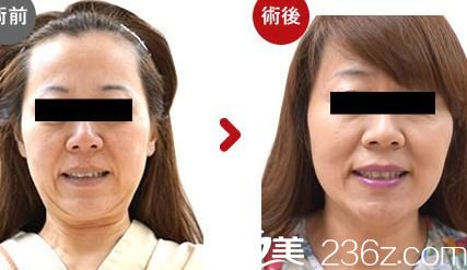  高牟禮線雕提升1