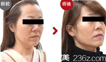  高牟禮線雕提升2