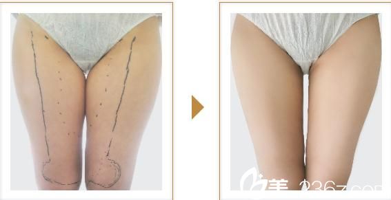 宮崎浩彥吸脂瘦身1 宮崎浩彥吸脂瘦身1