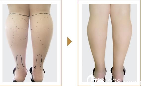 宮崎浩彥吸脂瘦身2 宮崎浩彥吸脂瘦身2