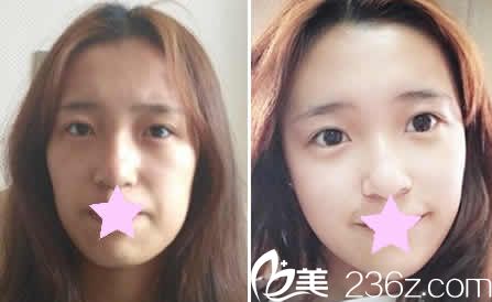 公布大同美神整形優(yōu)惠價(jià)格表：全臉自體脂肪填充低至9999元起 附隆胸真人案例