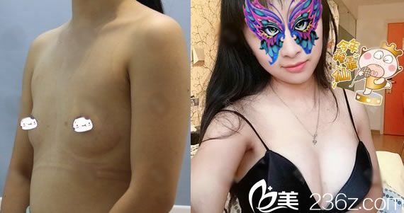 寧波建國整形假體隆胸2個月效果 寧波建國整形假體隆胸2個月效果