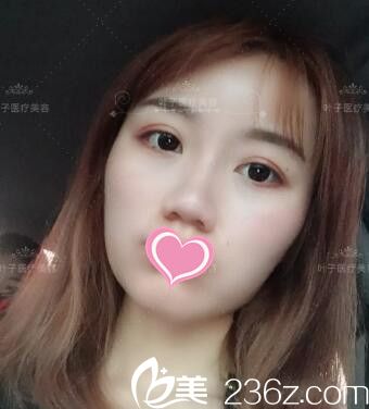 做雙眼皮修復(fù)術(shù)后20天恢復(fù)效果