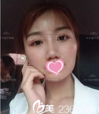 做雙眼皮修復(fù)術(shù)后30天恢復(fù)程度