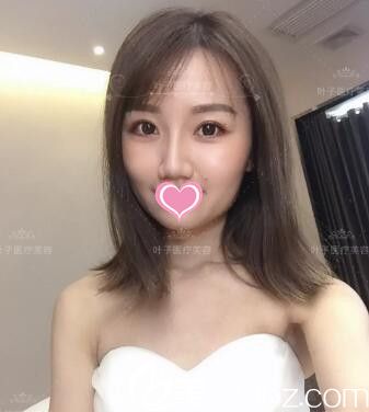 曾經(jīng)做雙眼皮失敗的我找整形醫(yī)院蔣新力幫我成功修復(fù)雙眼皮！