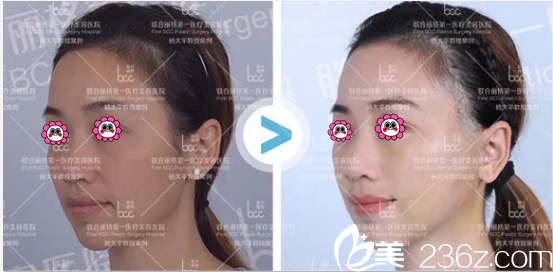 北京聯(lián)合麗格楊大平微拉美復(fù)合提升術(shù)案例