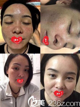 昆明韓辰皮秒祛斑案例