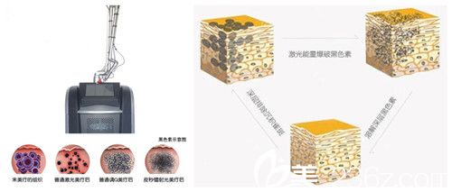 韓辰整形醫(yī)院蜂巢皮秒激光祛斑