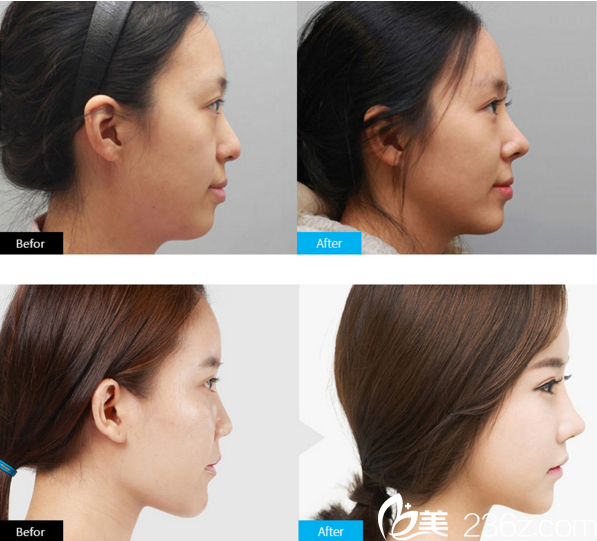 金虎吉院長假體隆鼻真人 金虎吉院長假體隆鼻真人