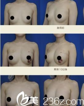 酒井直彥自體脂肪豐胸