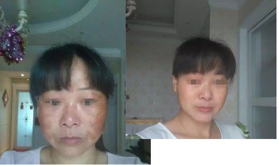 宜春祛斑哪家強(qiáng)？來圍觀這有兩位深受斑點困擾的求美者的祛斑經(jīng)歷