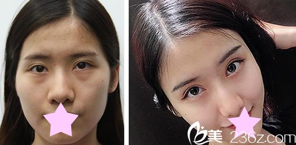 韓國TheOne整形金相耿自體脂肪面部填充前后效果對比圖