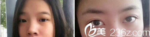 雙眼皮案例 雙眼皮案例