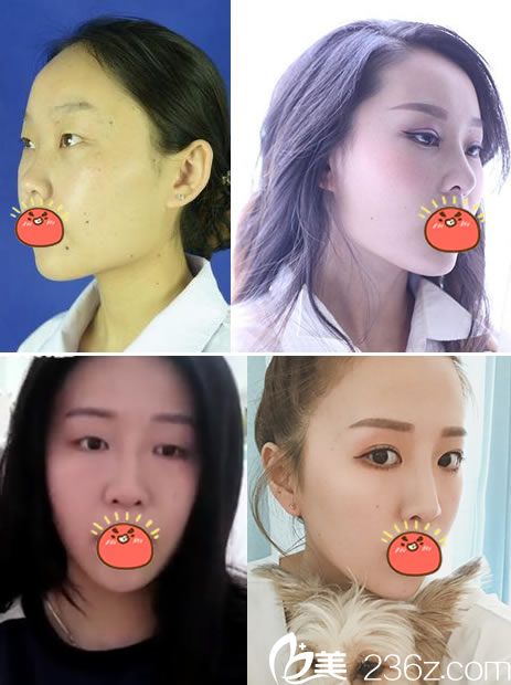 紹興維美<!--<i data=20240703-sp></i>-->輝做雙眼皮案例效果 紹興維美<!--<i data=20240703-sp></i>-->輝做雙眼皮案例效果