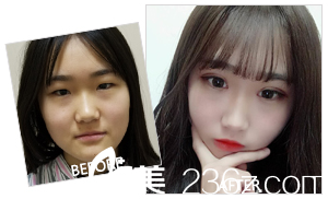 王來奎醫(yī)生眼鼻整形案例