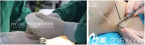 娜綺麗假體隆胸手術(shù)過程中