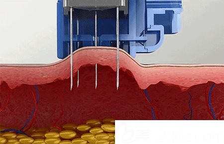 洛陽毛大夫注射