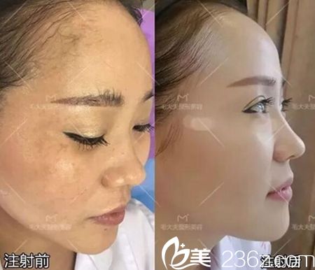 洛陽毛大夫注射案例