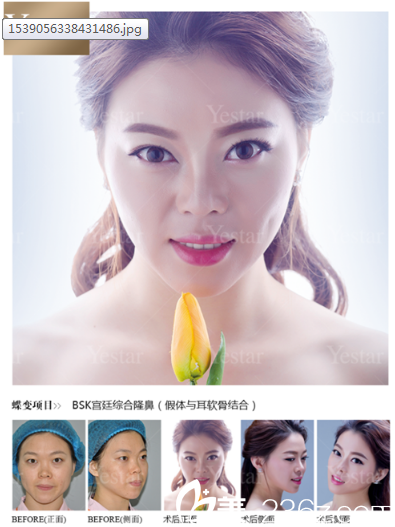 深圳yestar藝星整形魏鑫銘做的隆鼻子案例