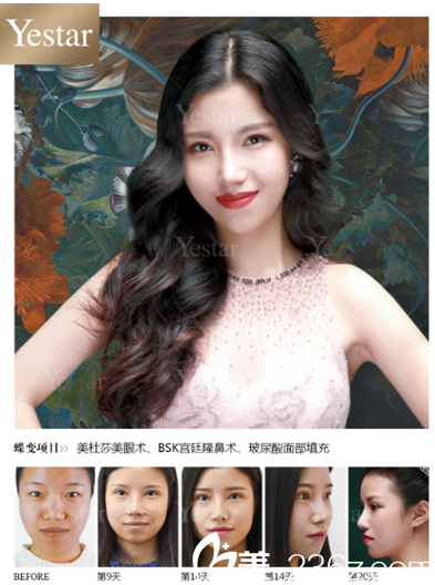 深圳yestar魏鑫銘做的美杜莎綜合美眼雙眼皮和隆鼻案例
