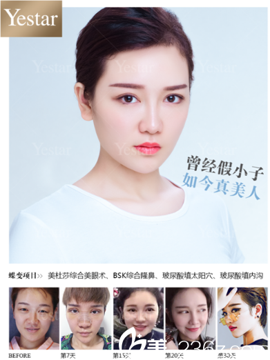 深圳藝星整形醫(yī)院魏鑫銘醫(yī)生雙眼皮隆鼻案例