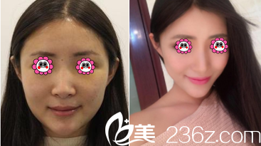 北京田永成醫(yī)院自體脂肪面部填充案例