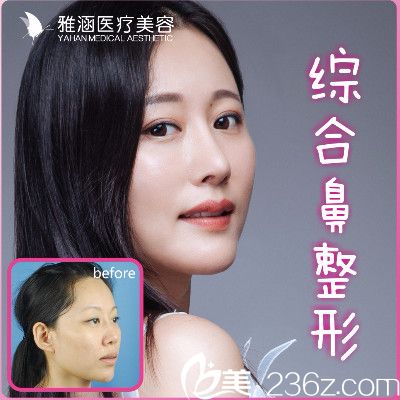 深圳雅涵隆鼻大王高山肋軟骨鼻綜合隆鼻子案例