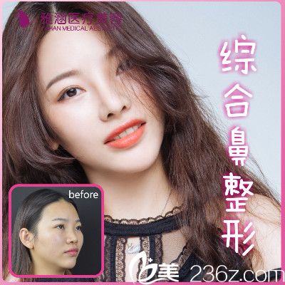 深圳雅涵隆鼻大王高山做的鼻綜合隆鼻案例