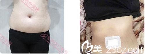廣州軍美王世虎腰腹部環(huán)吸案例效果對比 廣州軍美王世虎腰腹部環(huán)吸案例效果對比
