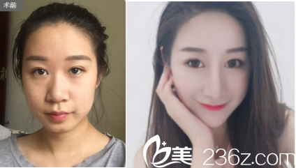 李德慶鼻綜合案例