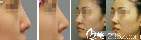 武漢中翰整形<!--<i data=20240703-sp></i>-->隆鼻案例 武漢中翰整形<!--<i data=20240703-sp></i>-->隆鼻案例