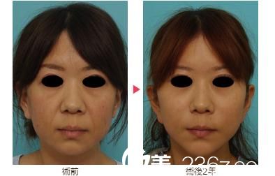 八事石坂美容外科醫(yī)院面部拉皮