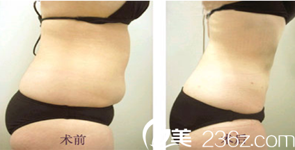 腰腹部抽脂手術(shù)前后對(duì)比