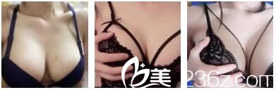 恢復(fù)過(guò)程中的自體脂肪豐胸術(shù) 恢復(fù)過(guò)程中的自體脂肪豐胸術(shù)