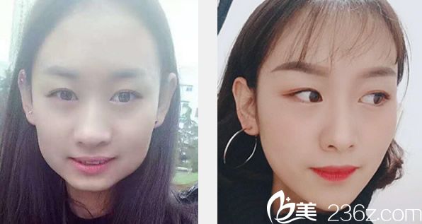 蘭州亞韓趙貴慶下頜角整形前后效果對比照片 蘭州亞韓趙貴慶下頜角整形前后效果對比照片